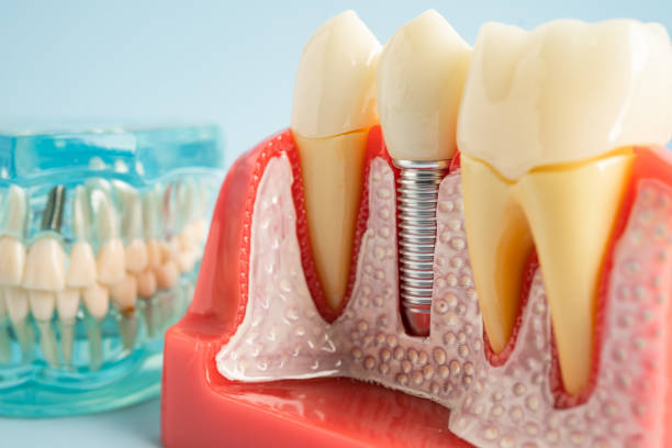 Best Root Canal Treatment  in Morgan, UT